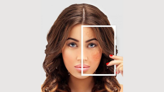 Dealing with Pigmentation and Discoloration